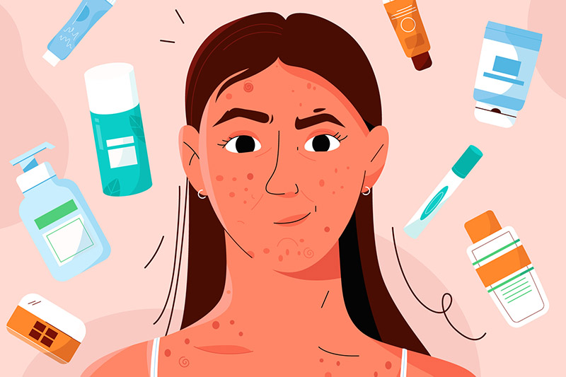 acne-hormonal